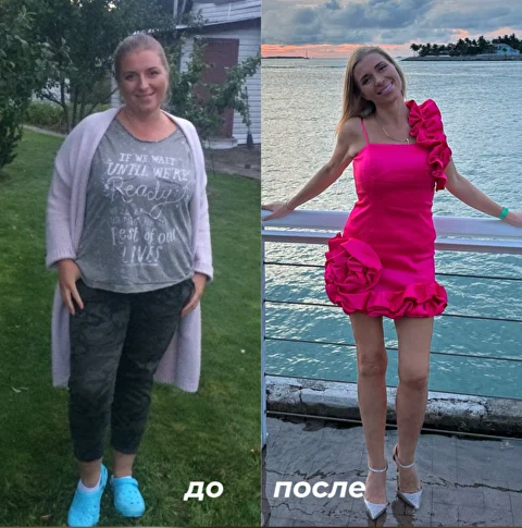 Пациентка до и после снижения веса